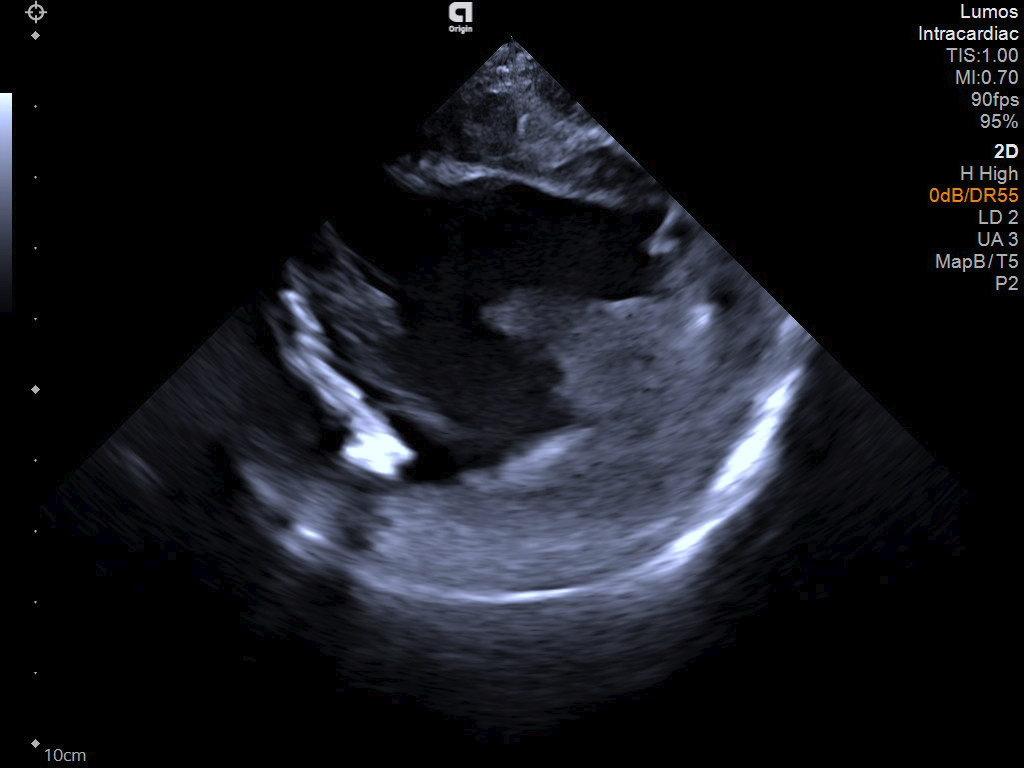 Left ventricle with ablation catheter visualization