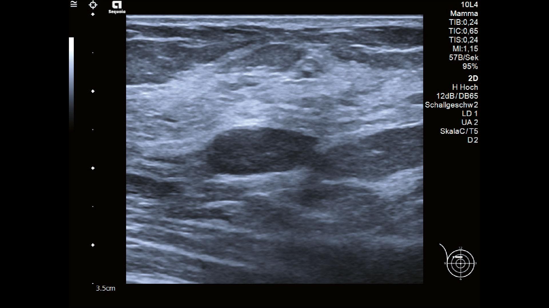 Casos prácticos de ultrasonido de mama - Siemens Healthineers Latinoamérica