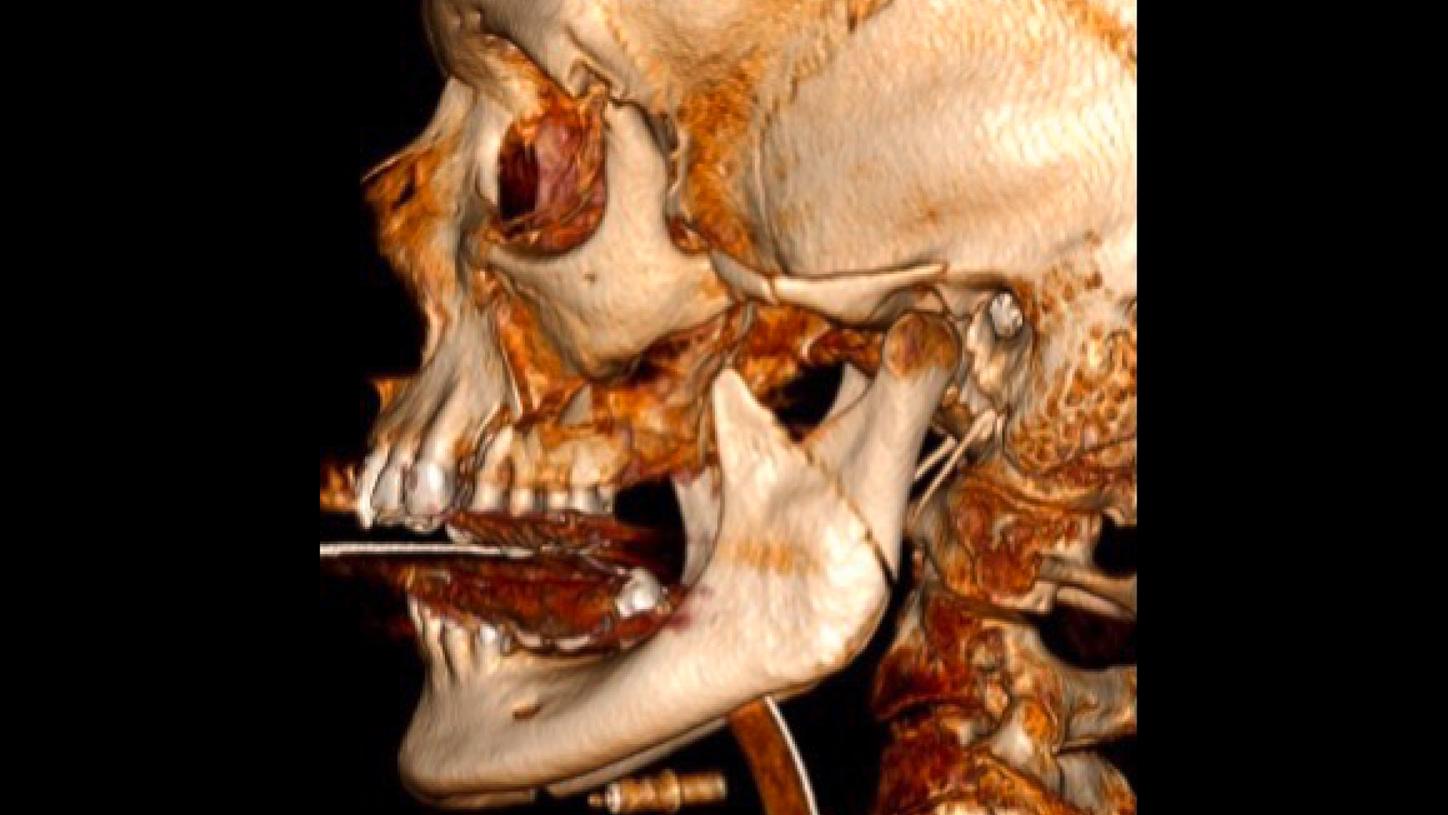 Fractura conminutiva panfacial compleja 03