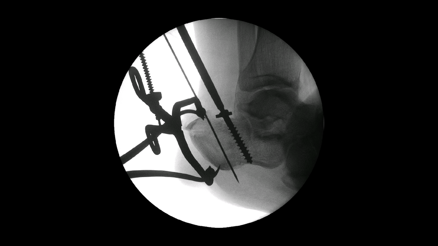 Calcaneus surgery with Cios Fit, a mobile 2D C-arm for surgery.