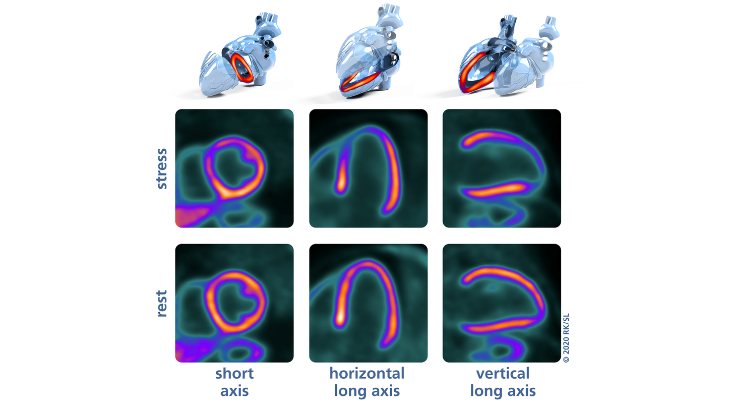 Adenosine stress (top) versus rest (bottom) 13N-ammonia PET/CT images in short-axis, horizontal long-axis, and vertical long-axis slices.