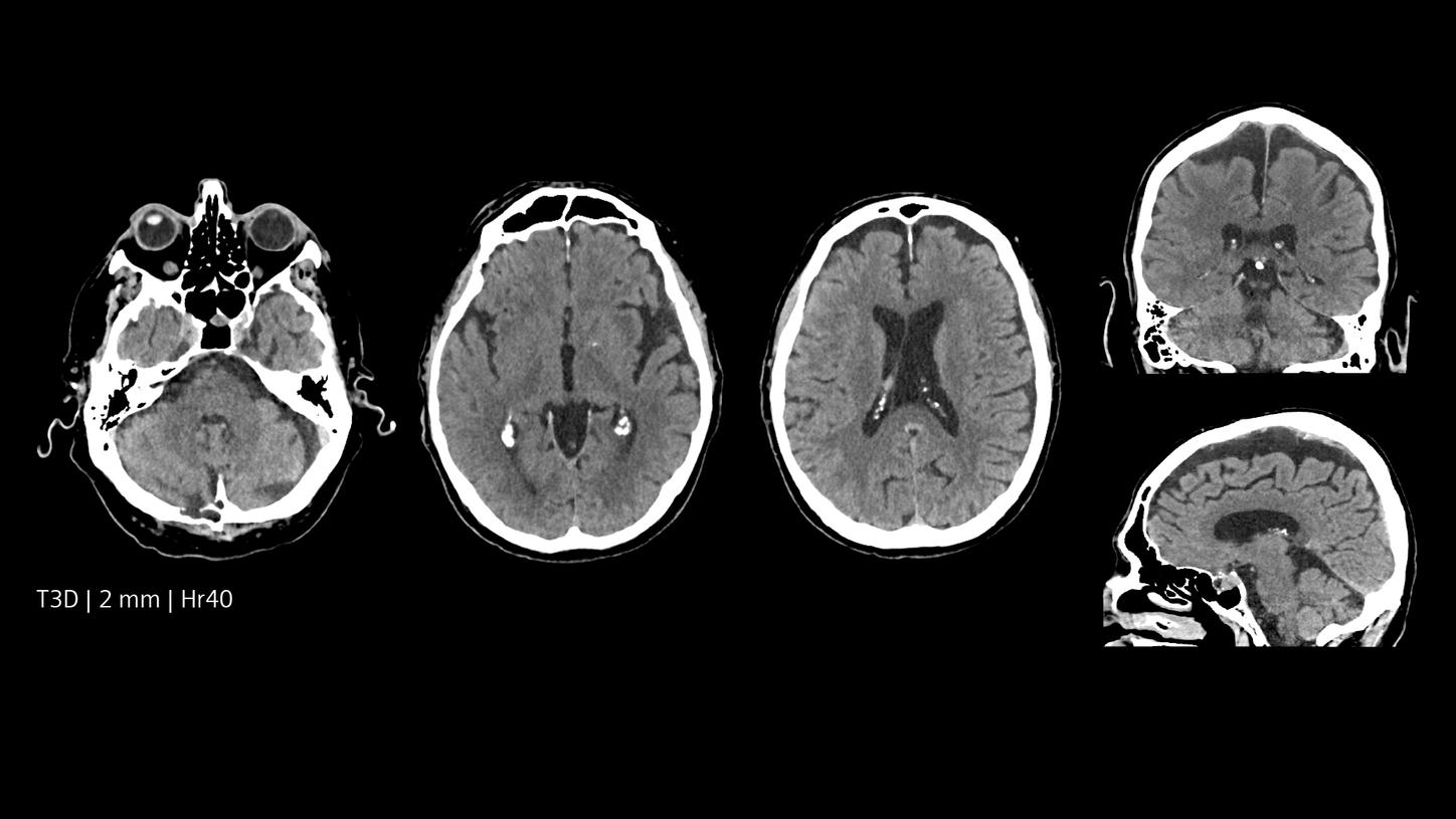 Routine native head imaging with NAEOTOM Alpha.