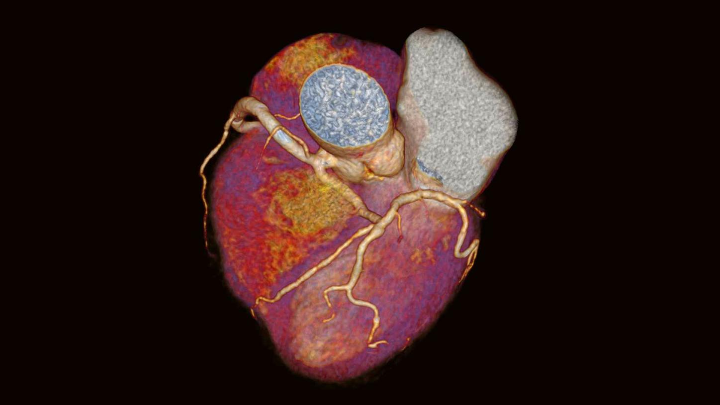 Coronary CTA Interpretation