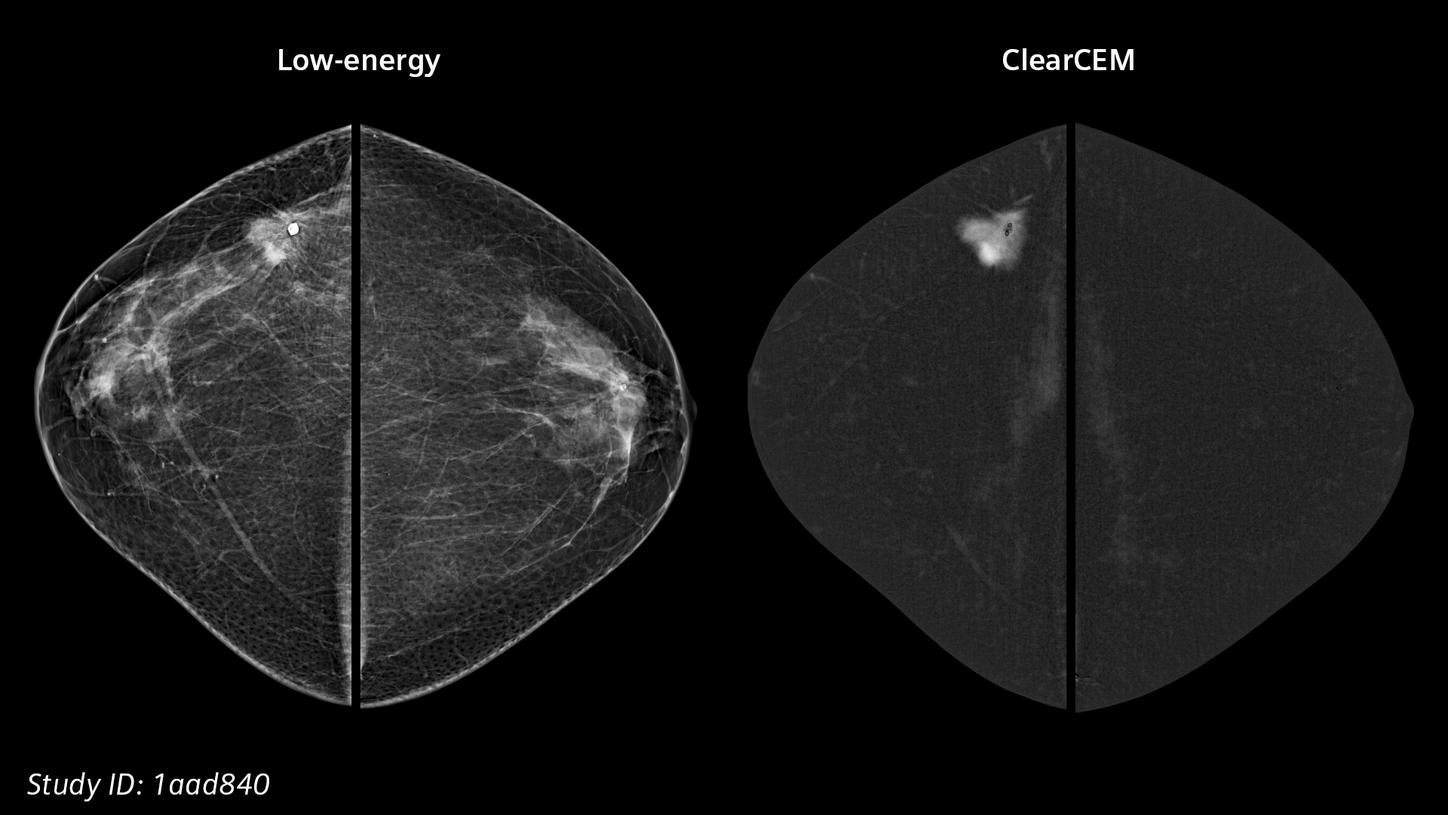 ClearCEM clinical case: Invasive ductal carcinoma