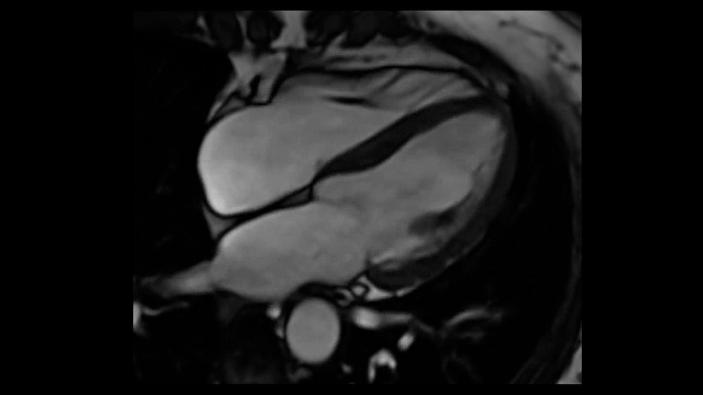 siemens-healthineers-mri-clinical-specialities-cardiovascular-thumbnail_16_9.png