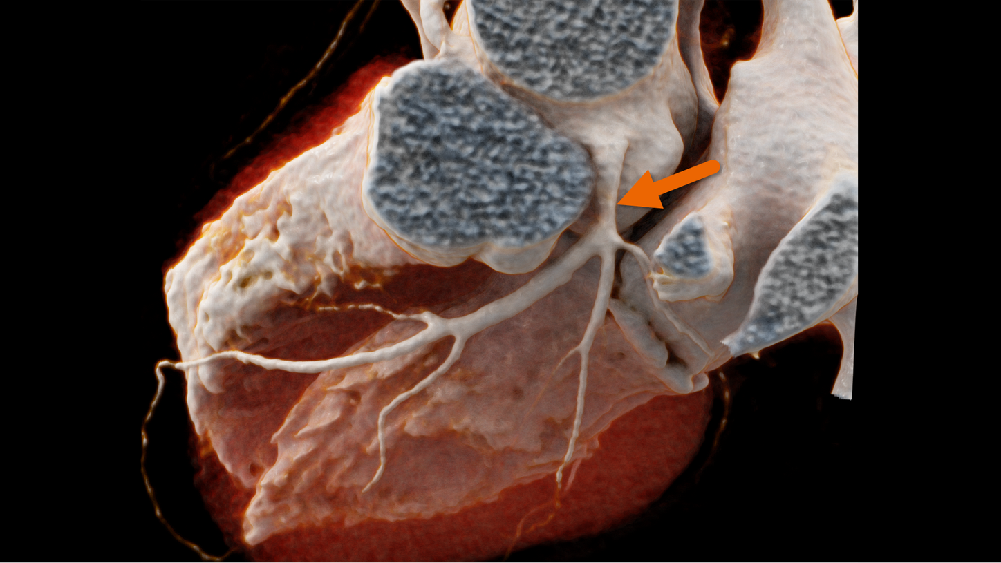 Evaluate even heavily calcified vessels with PURE Lumen