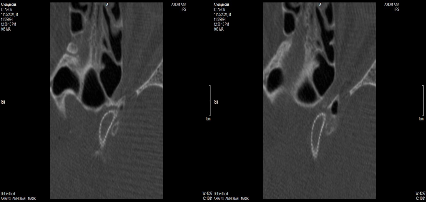 Fig A, B - Axial cuts DynaCT Micro showing better spatial resolutions allowing proper visualization of implanted flow diverter stent with no intra stent stenosis.