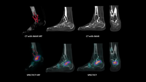 SPECT/CT in musculoskeletal medicine - Siemens Healthineers USA
