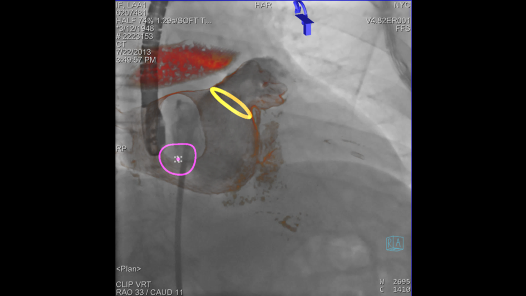 clinical image with syngo 2D/3D Fusion
