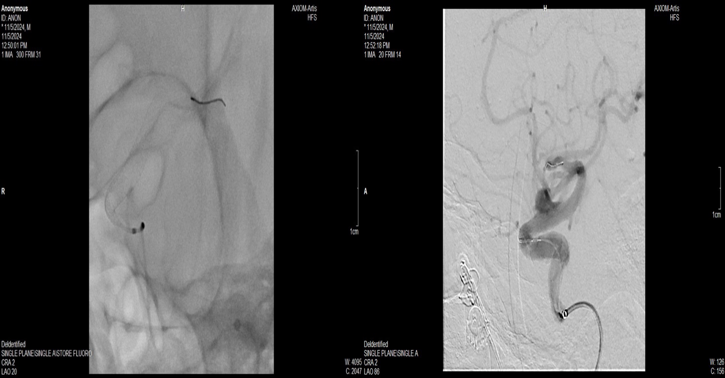 Fig A, B - Oblique view of Fluoroscopy and DSA Roadmap showing the placing of the flow diverter within the parent vessel
