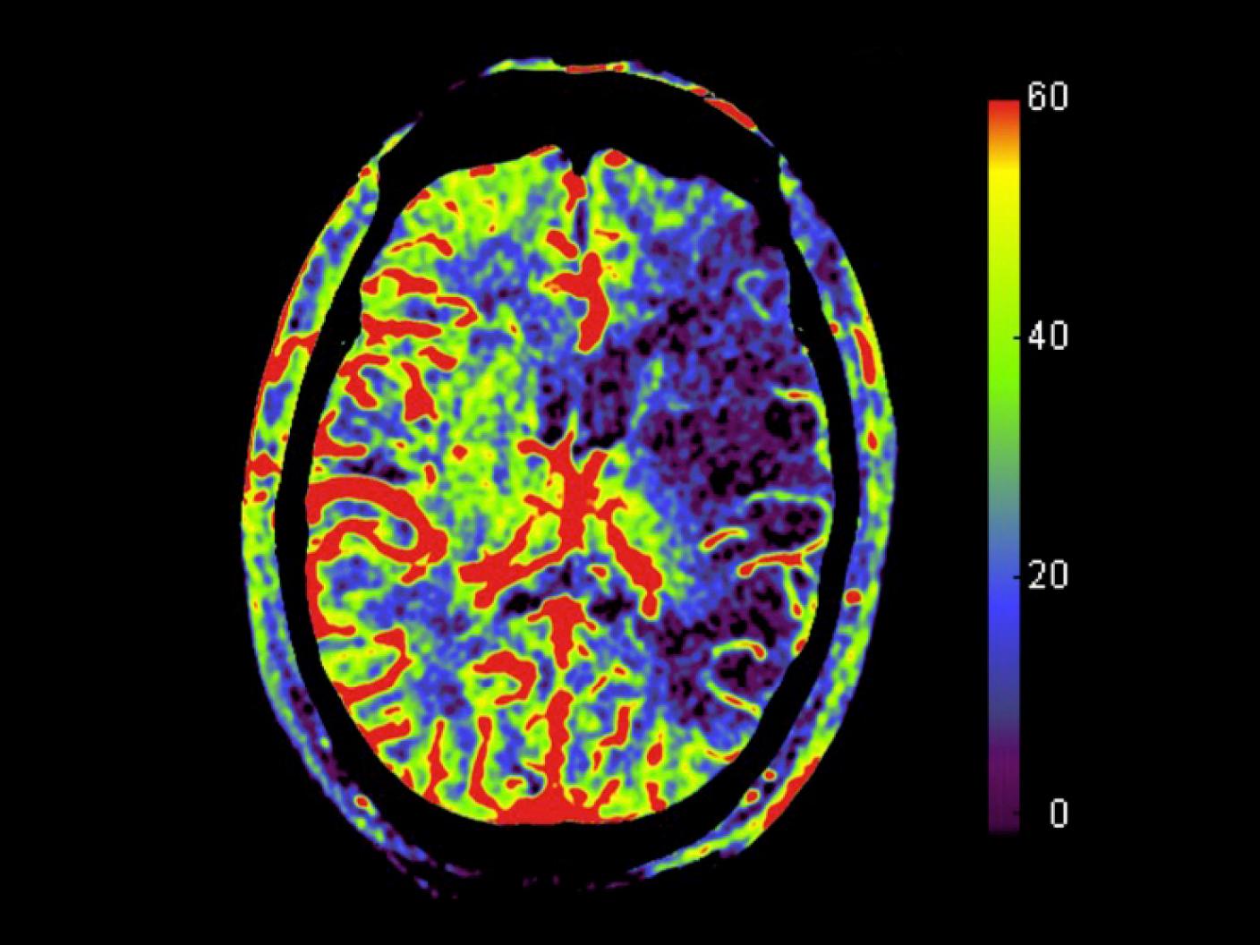 Mechanical thrombectomy of left MCA occlusion