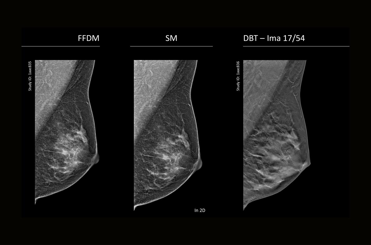 Microcalcificaciones pleomórficas en mama izquierda: diagnóstico de carcinoma ductal in situ grado 2