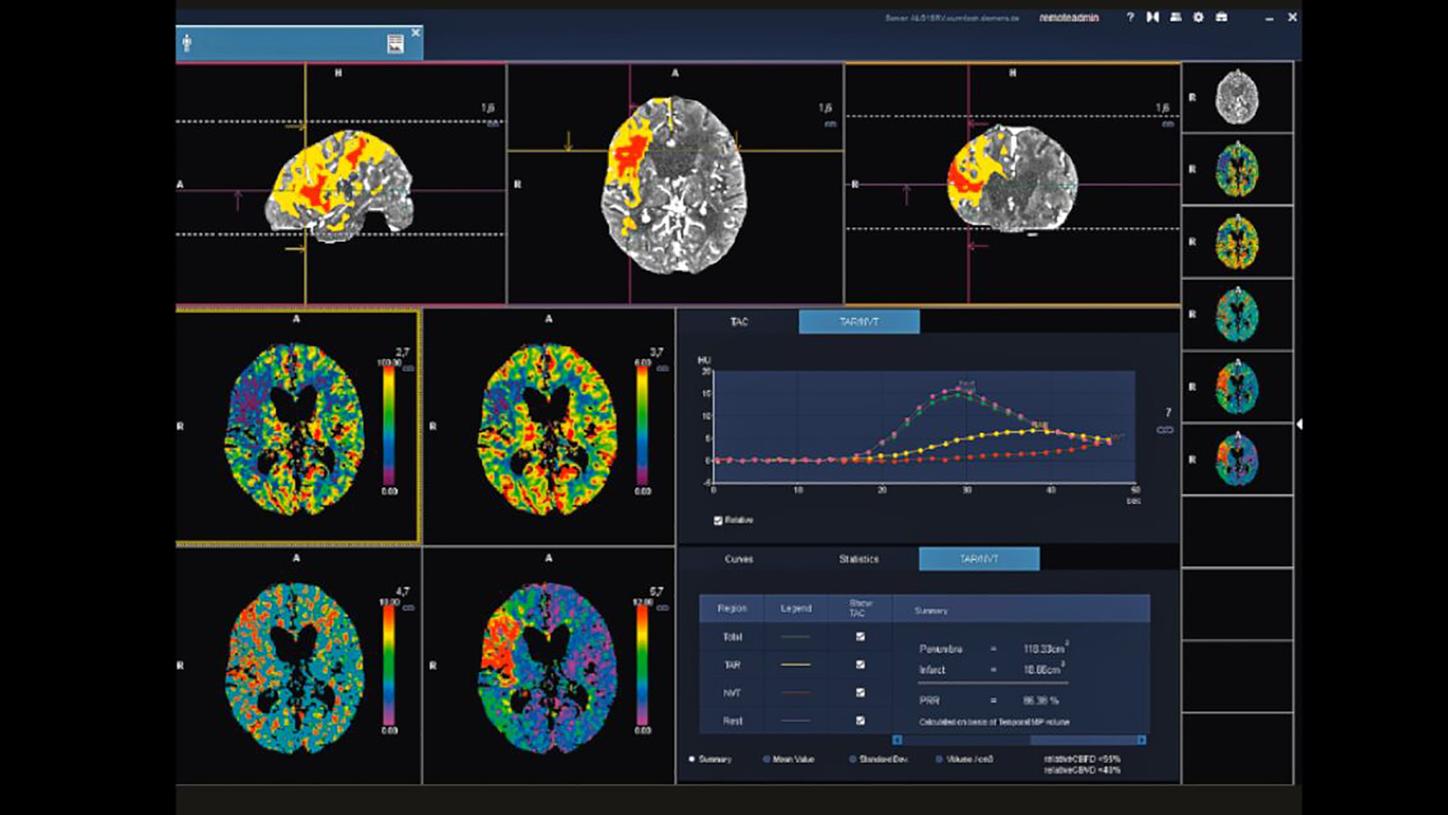 CT-Bildgebung in der Neurologie