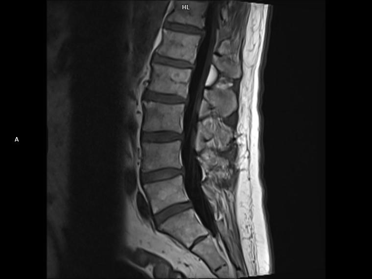 Sagittal T1 FLAIR-MAGNETOM Lumina/Coil-Spine 24/Resolution-320/Scan Time-2:36