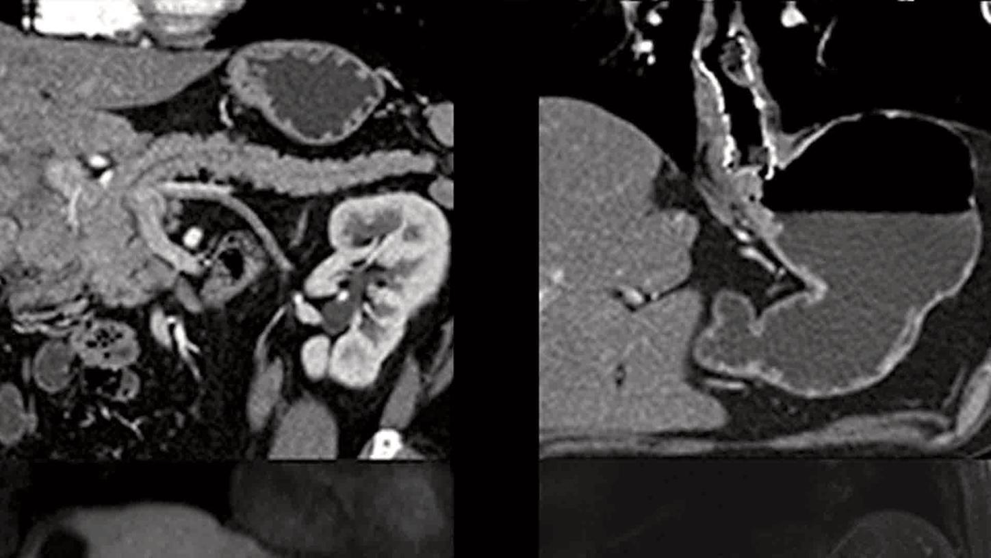 MRI – MDCT Abdomen