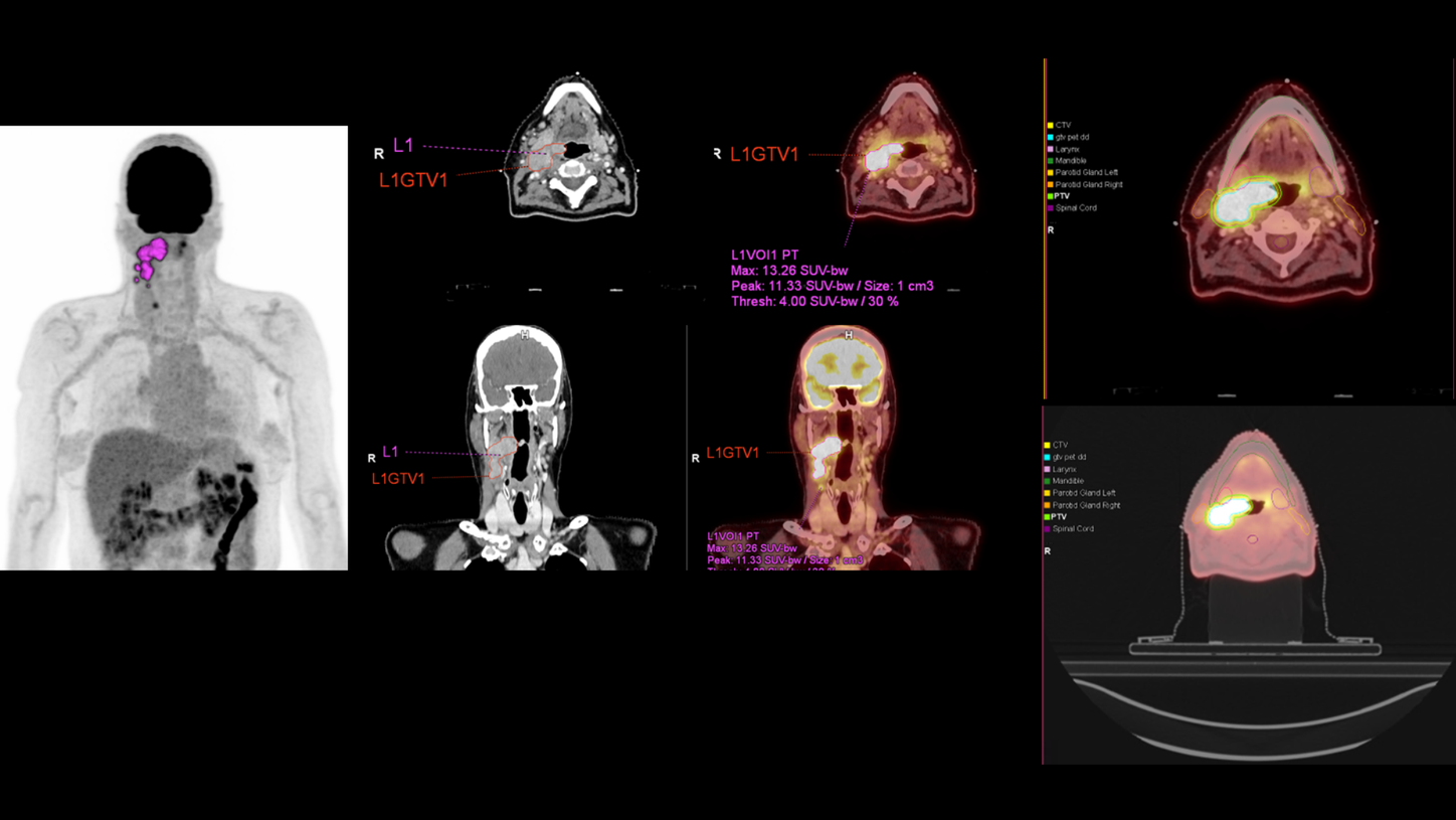 Head & Neck Cancer