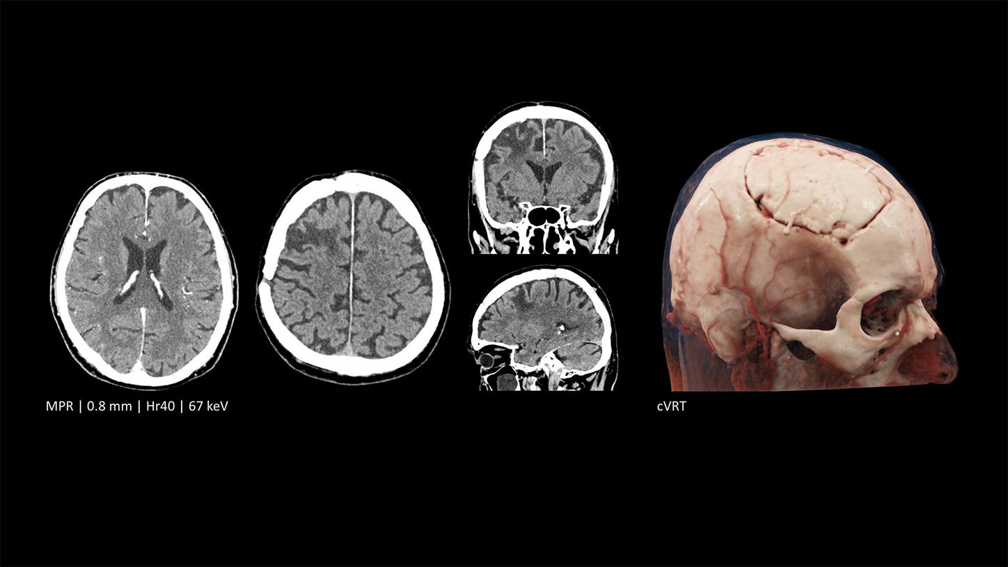 Head follow-up imaging after surgical procedure with NAEOTOM Alpha.Pro