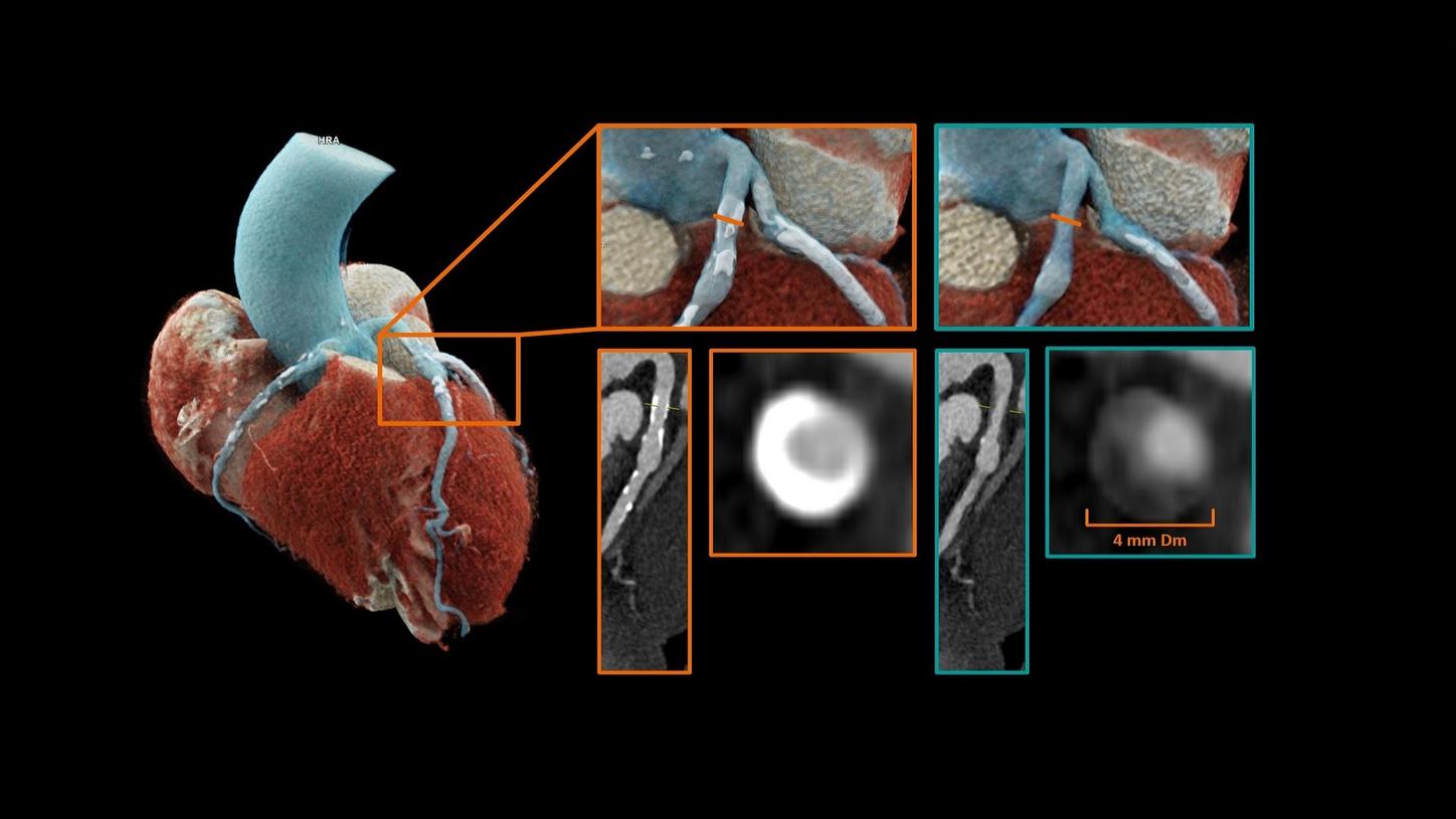 「NAEOTOM Alpha」で撮影した心臓における石灰化除去　モナコ心臓血管センター　提供