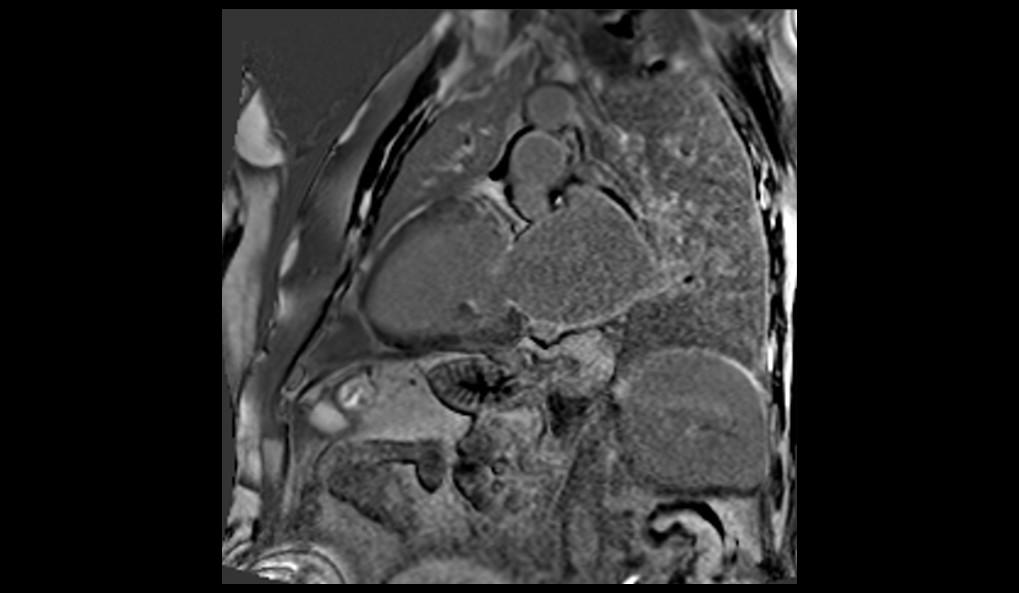 CT image of retro-ocular masses causing exophthalmos along with bilateral perinephric, pericardial, and pelvic exudates