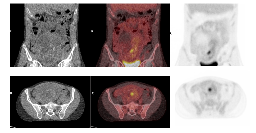 PET/CT in pregnant patients