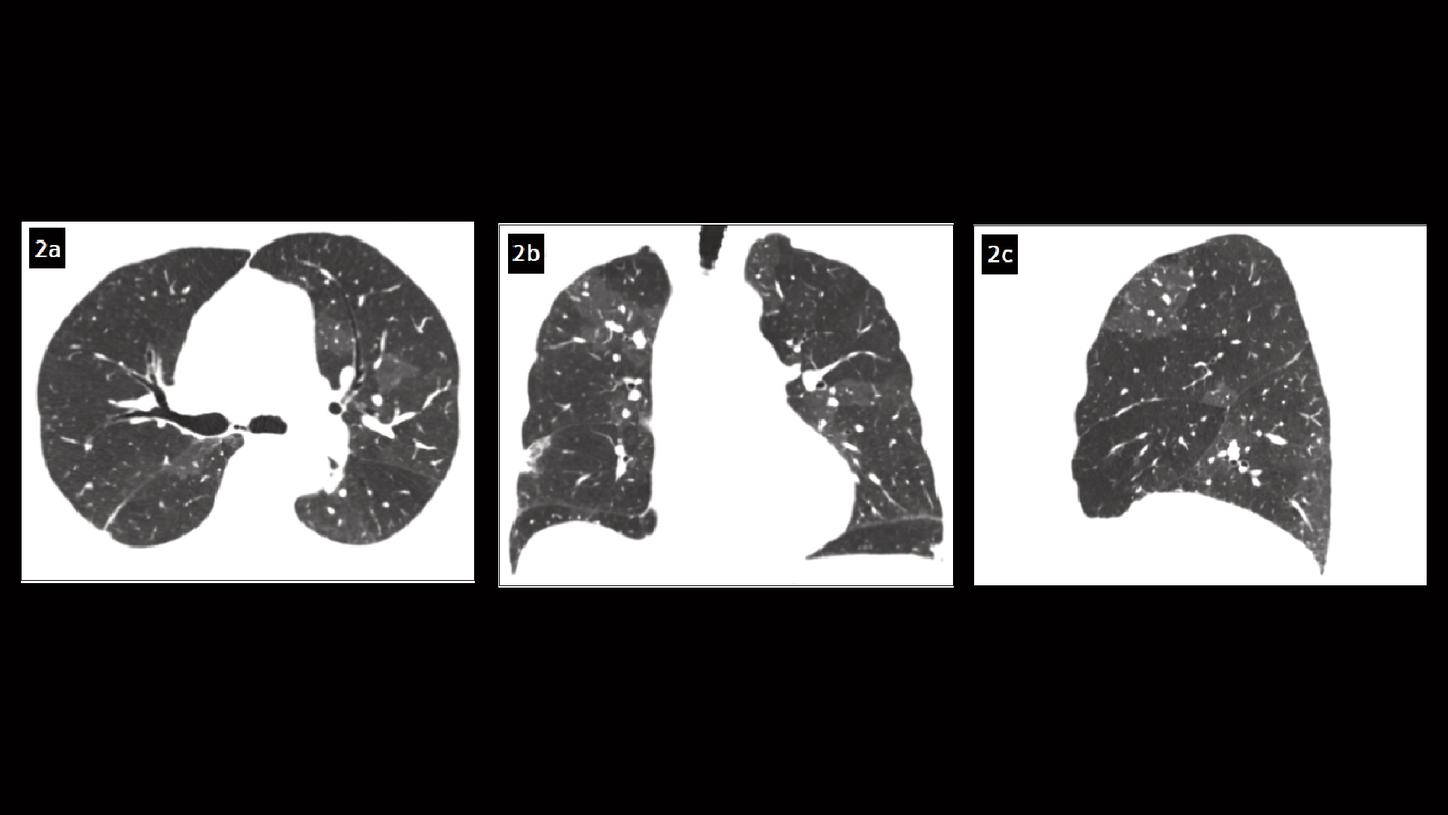 Axial and sagittal MPR images show a pattern of mosaic perfusion in both lungs.