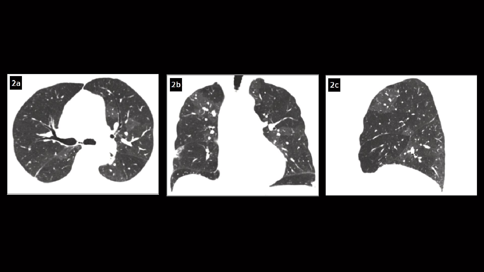 Chronic thromboembolic pulmonary hypertension diagnosed after COVID-19 ...