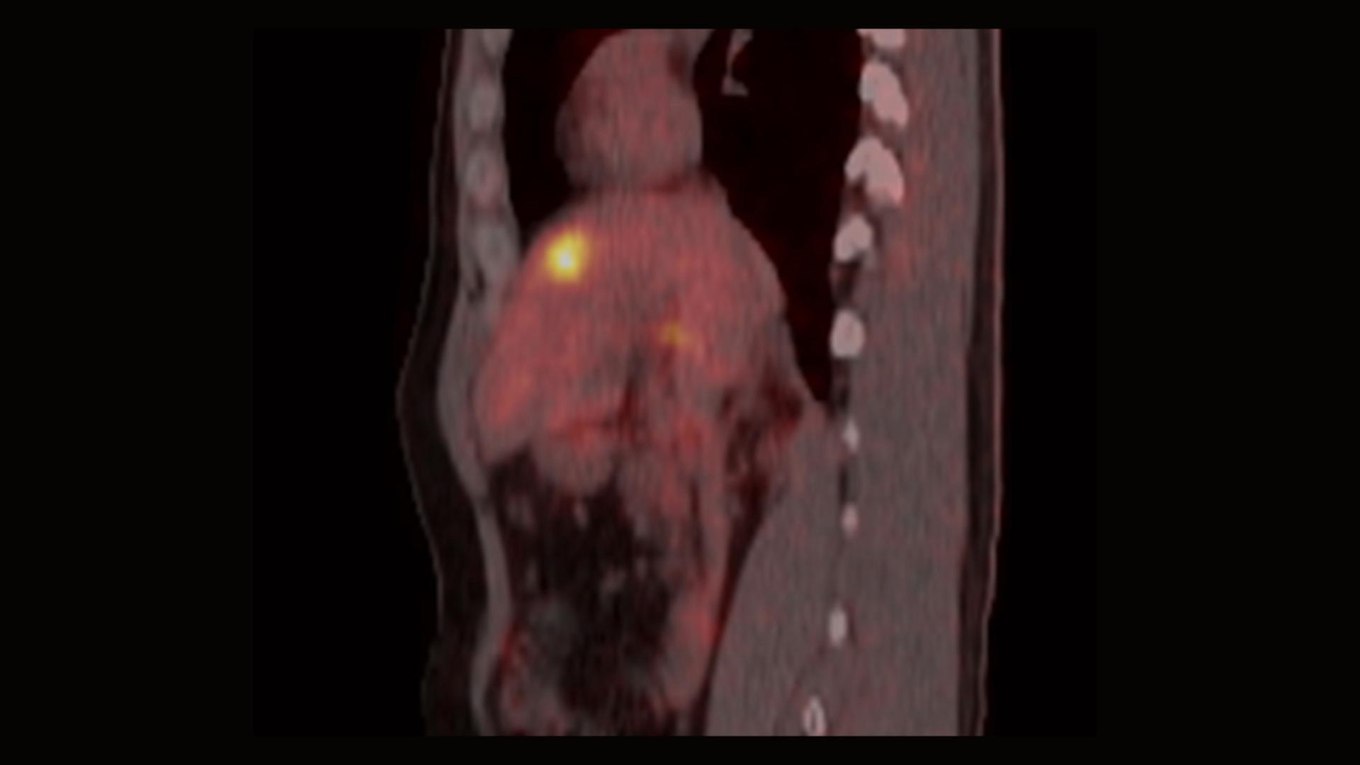 Liver Cancer Management - Siemens Healthineers