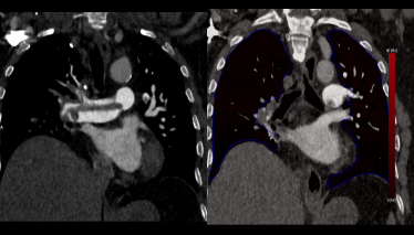 lung image