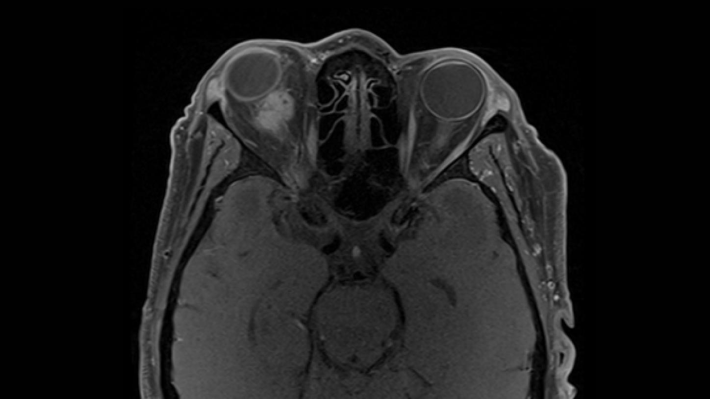 meningioma óptico