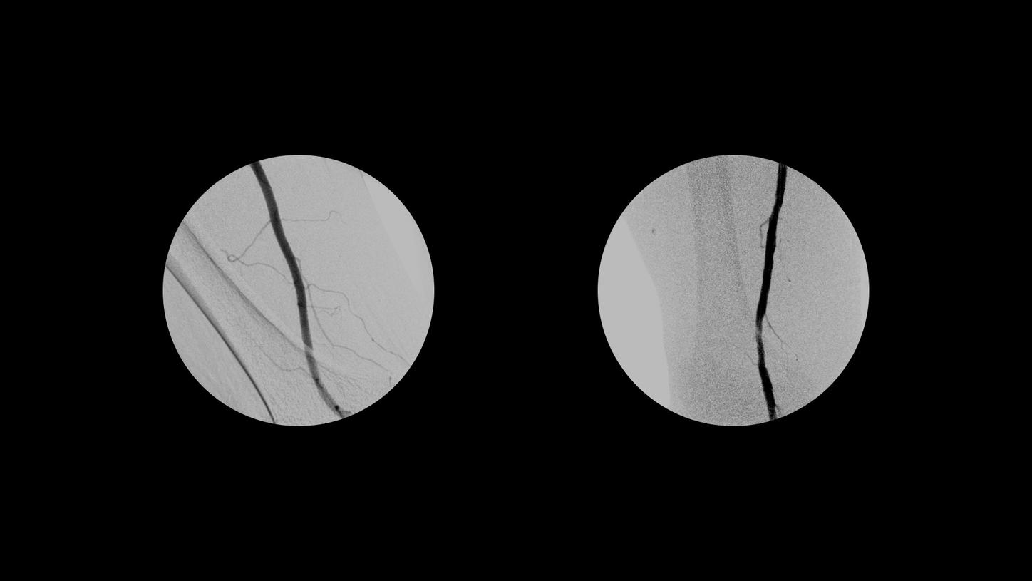A peripheral arterial disease procedure with Cios Select, a 2D C-arm for surgery.
