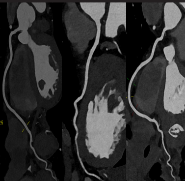 MPR Reformat from 0.4 mm slice thickness1