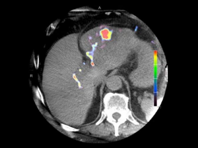 Syngo dyna pbv Tübingen