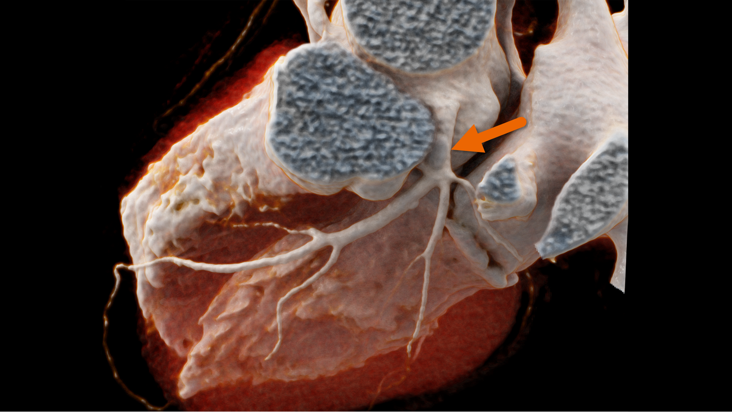 Evaluate even heavily calcified vessels without PURE Lumen