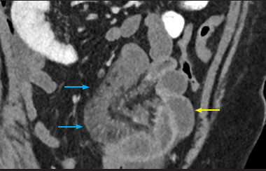 Fig. 9: Blue arrow showed focal segment of small bowel devoted from iodine /contrast uptake, yellow arrow showed normal mucosal enhancement.