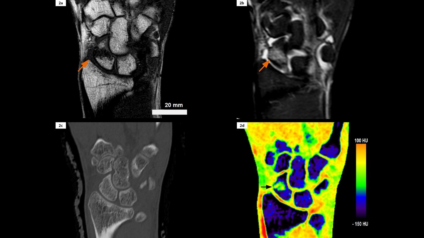 Coronal reformats from MRI T1w, MRI STIR, conventional CT and DECT color-coded VNCa. BME through the waist of the scaphoid is clearly shown in both MRI and DECT. The fracture is not visible in conventional CT.