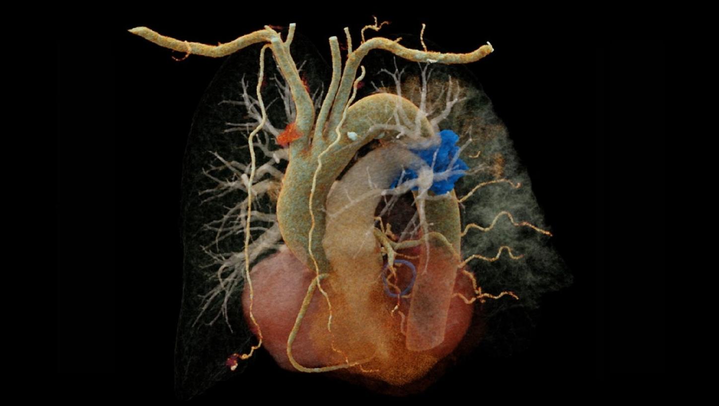 An oblique view of a VRT reconstruction of the thoracic vessels shows an embolus in the left pulmonary artery and a cloud-like visualization of consolidations in the left lung.