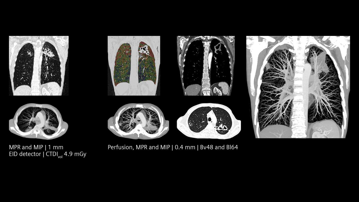 CM enhanced lung scan for follow-up