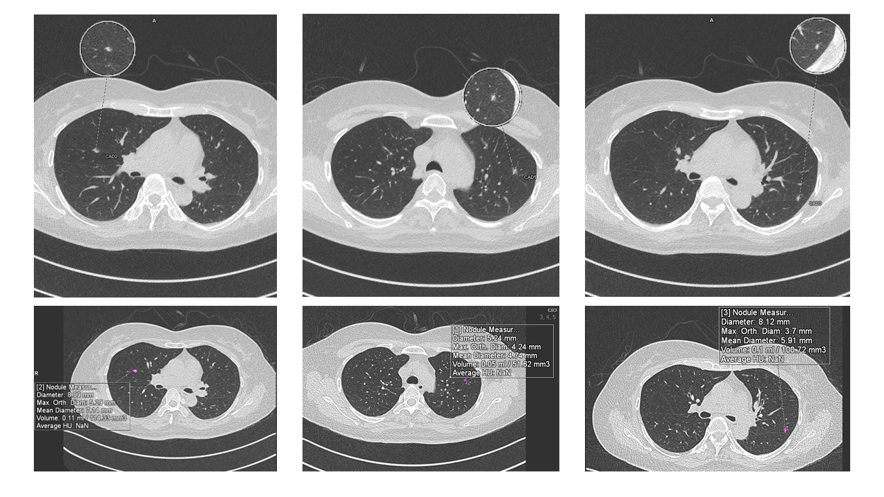 Computer assisted diagnosis (CAD)