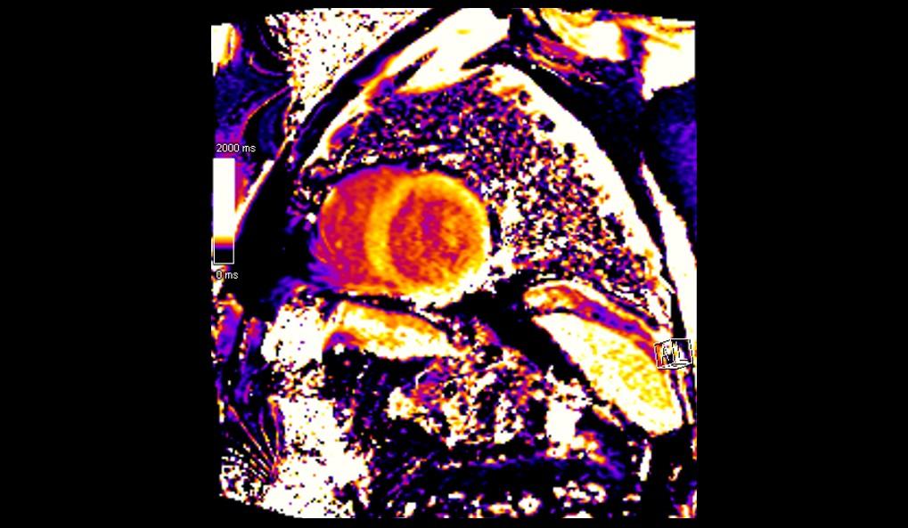 Cardiomiopatía diltada 