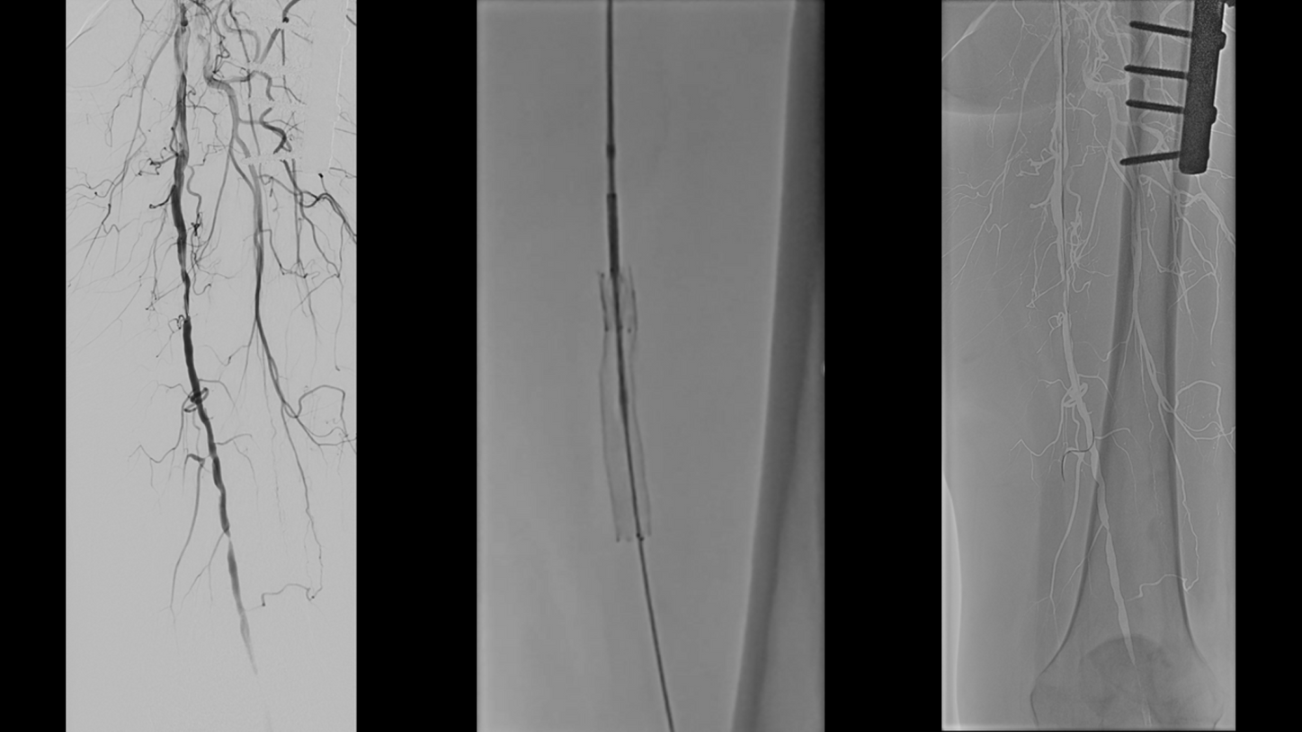Percutaneous Transluminal angioplasty (PTA)