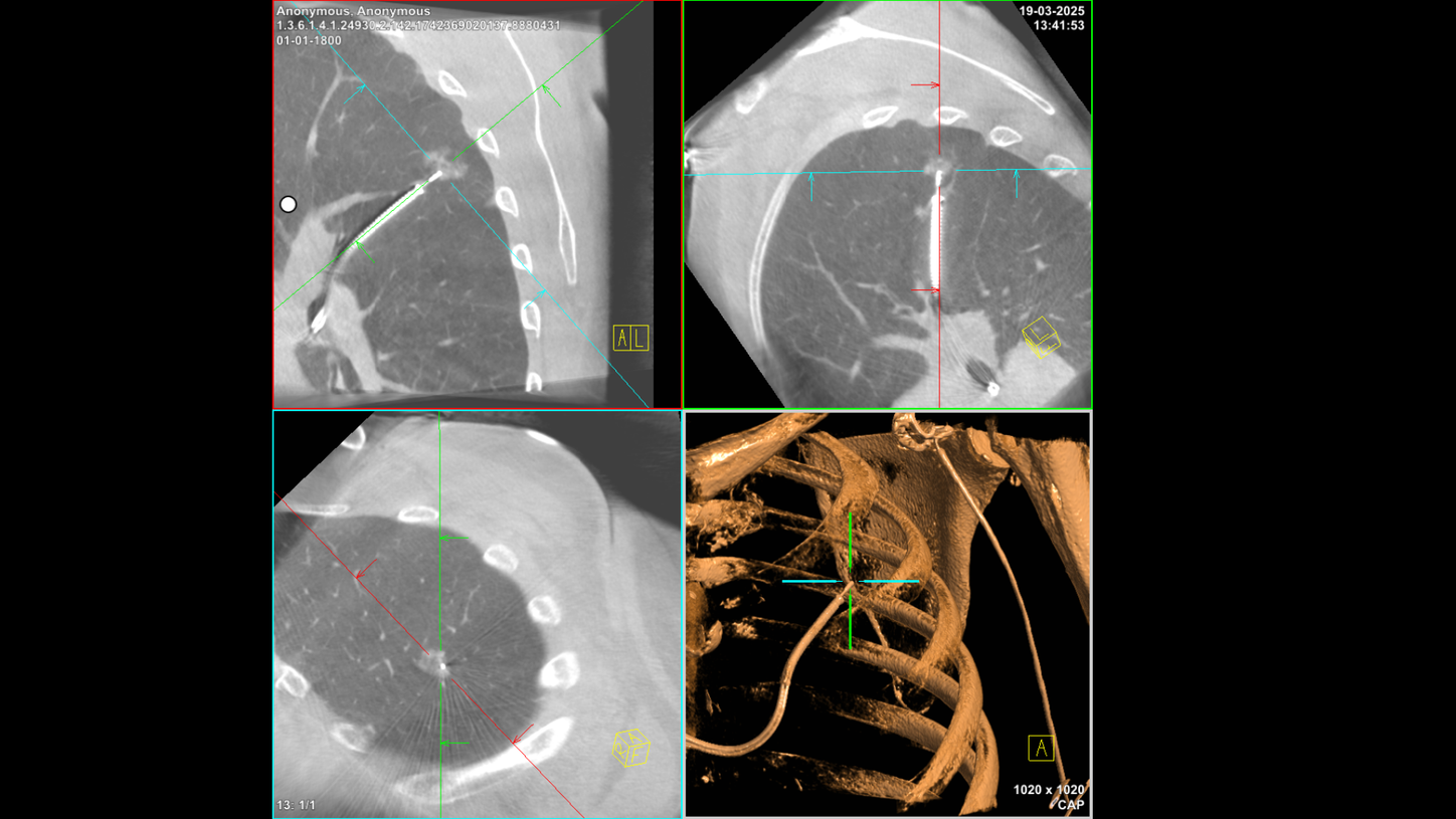 Tool-in-lesion confirmation with Cios Spin, a 3D C-arm for pulmonology