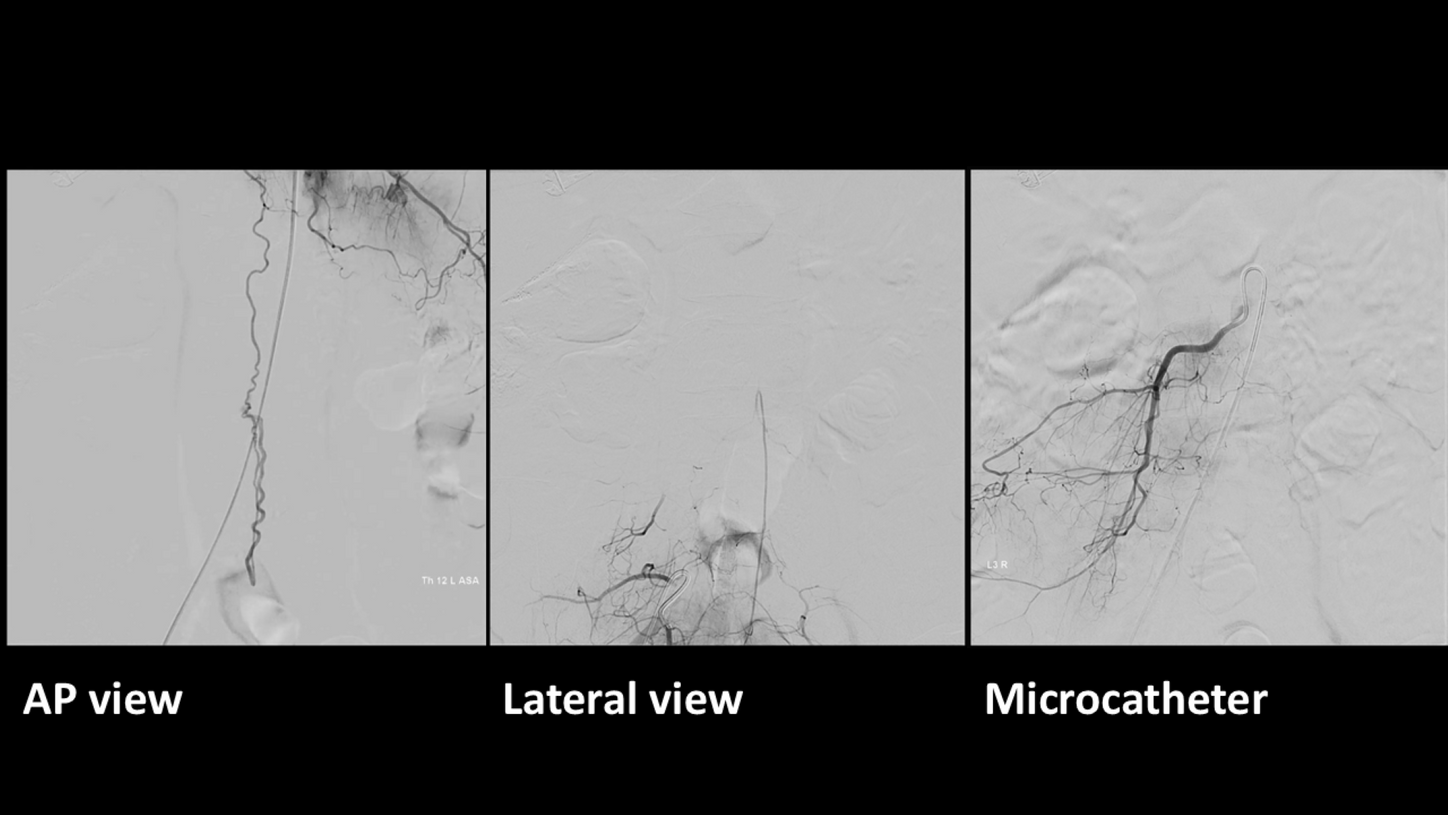 DSA with OPTIQ AI AP view; DSA with OPTIQ AI lateral view; DSA with OPTIQ AI microcatheter
