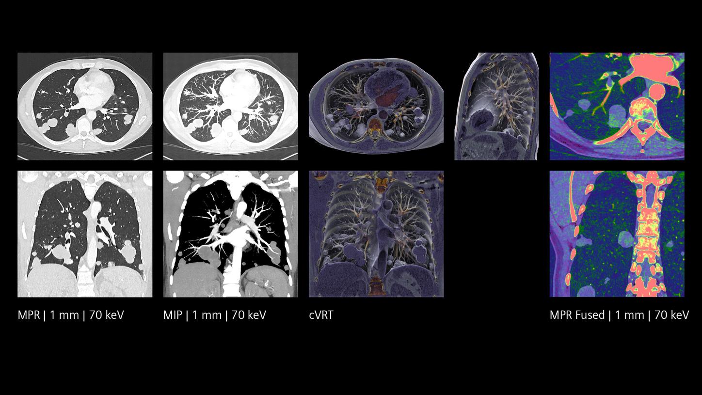 The combination of morphological and functional information provides pulmonary embolism assessment in one scan.