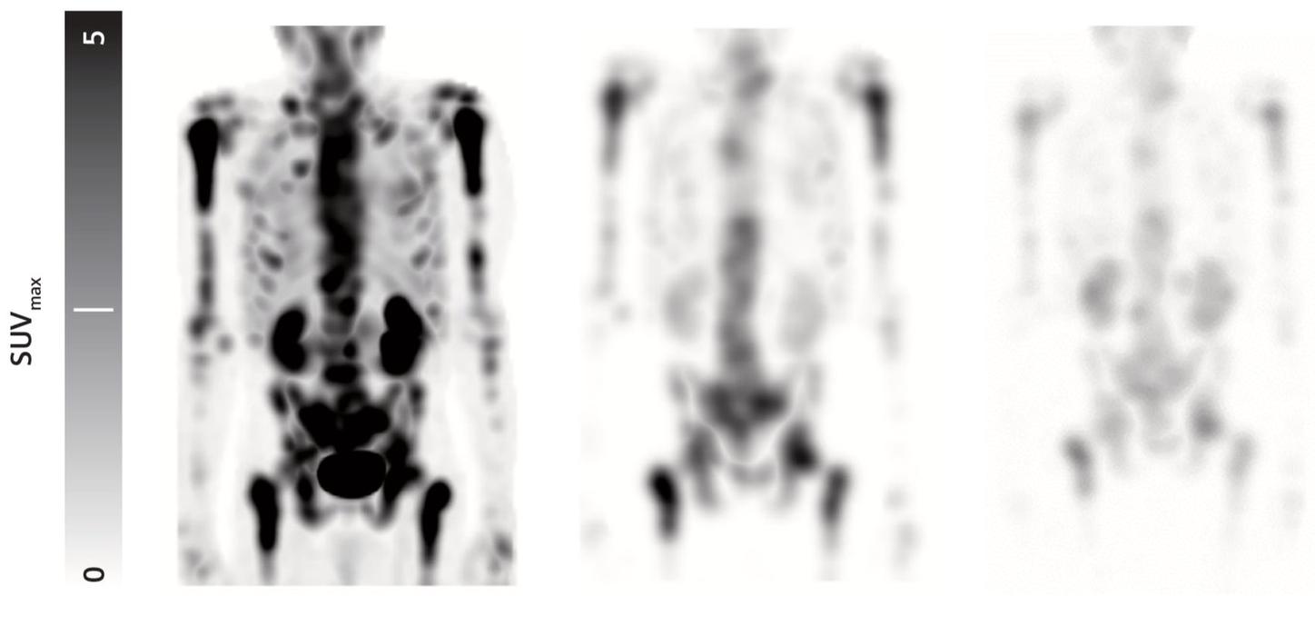 From left to right: coronal SPECT mip cycle 1, coronal SPECT mip cycle 3, and coronal SPECT mip cycle 6.