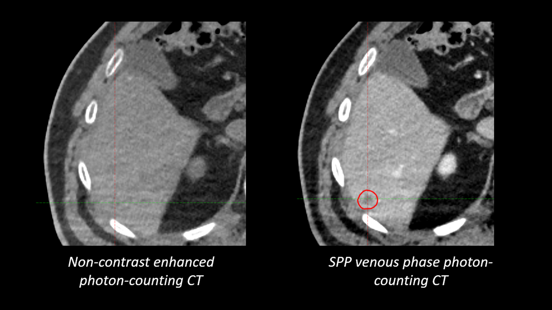 Normal Ctv Rad NAEOTOM Alpha.Prime RT Pro Edition - Siemens Healthineers