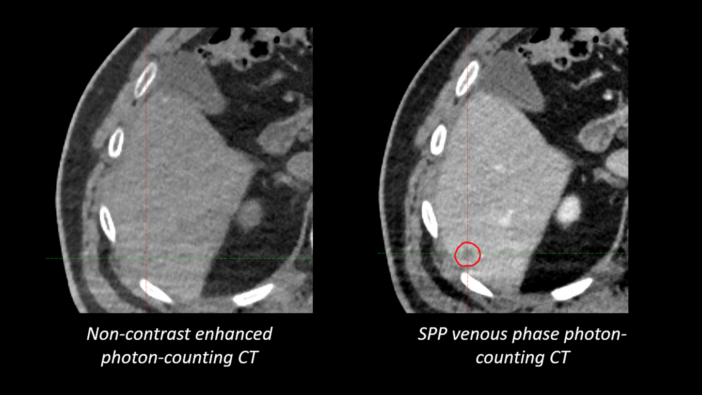 Liver - Small (~4 mm) lesions are usually visible on contrast enhanced PCCT images