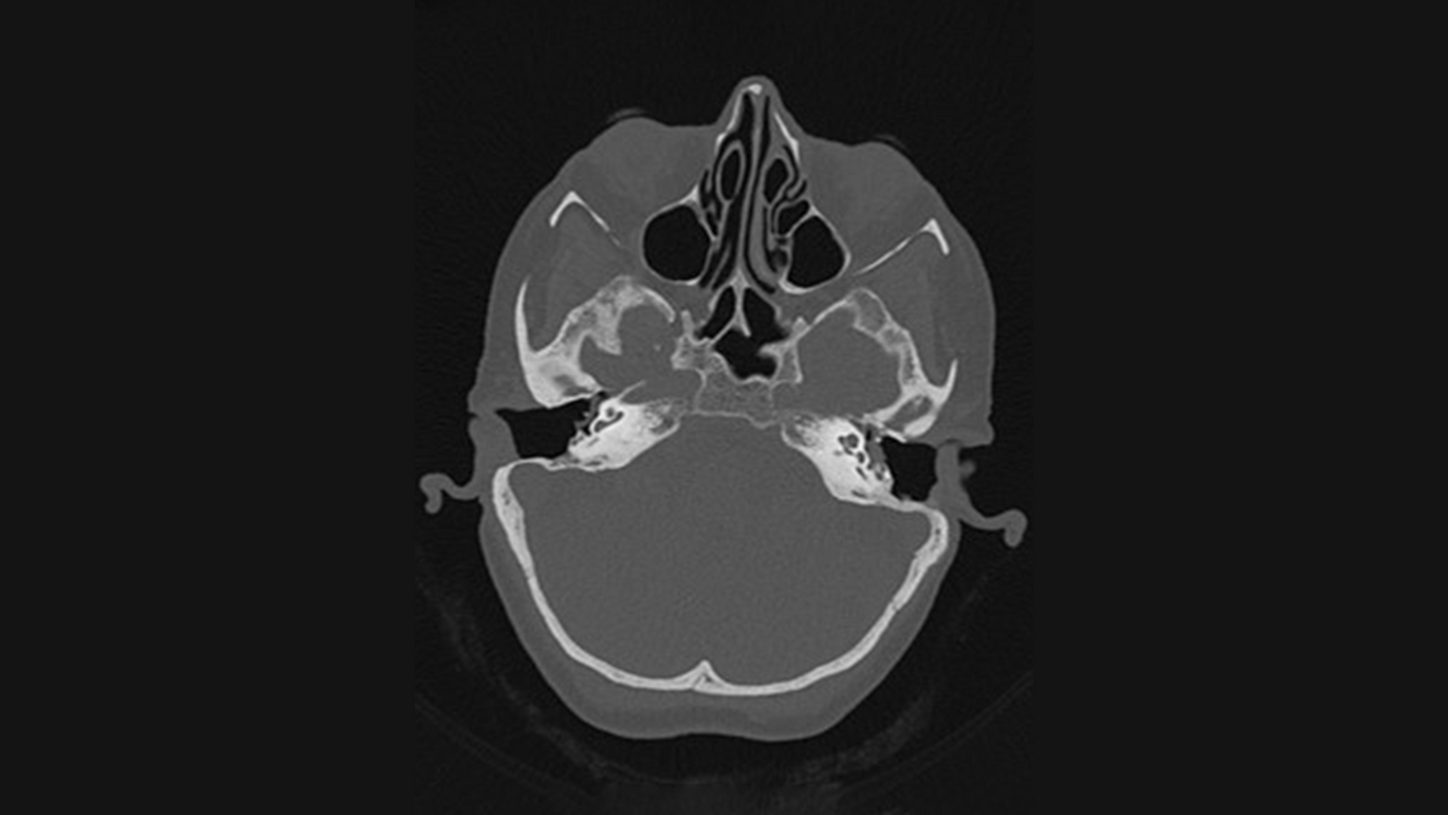 SOMATOM Pro.Pulse in neurology