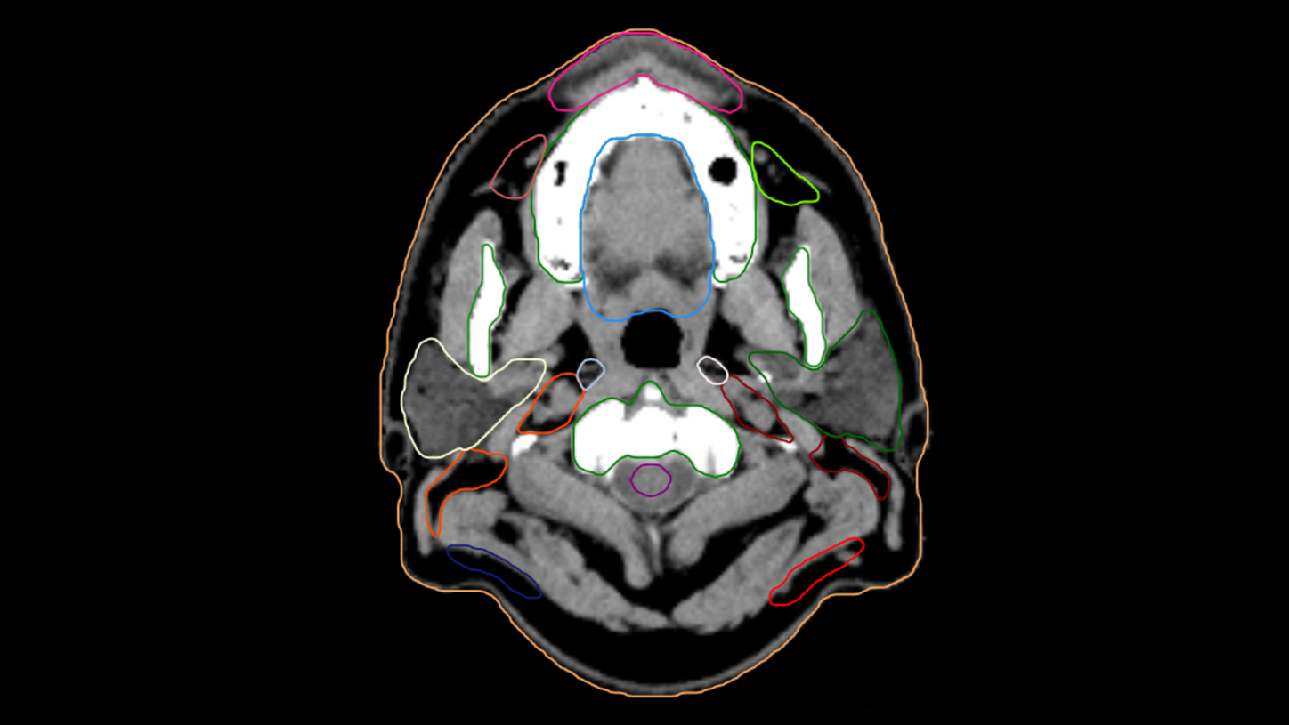 3D rendering of the CT image in the TPS showing AI-Rad Companion Organs RT generated contouring of organs-at-risk.