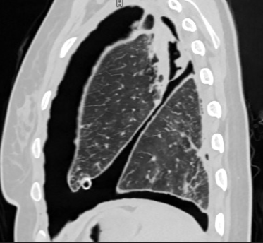 Fig.1 : Chest radiograph (PA view) and HRCT multiplanar reconstructions demonstrating a large left-sided hydropneumothorax with associated mediastinal shift.
