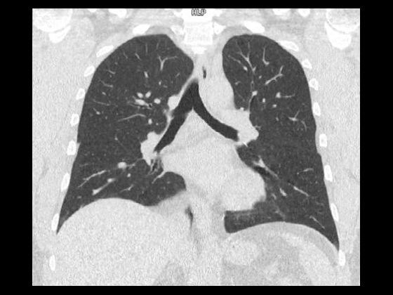 Tin Filter Low Dose Lung Screening